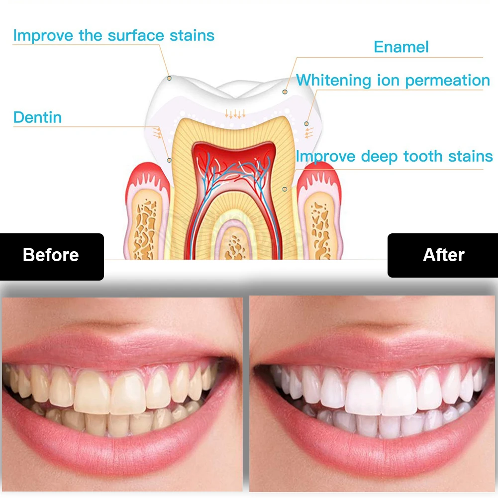 치과 치아 미백 키트 미니 16 LED 콜드 라이트 3 - Teeth Whitening Hydrogen Peroxide 리뷰 및 가격