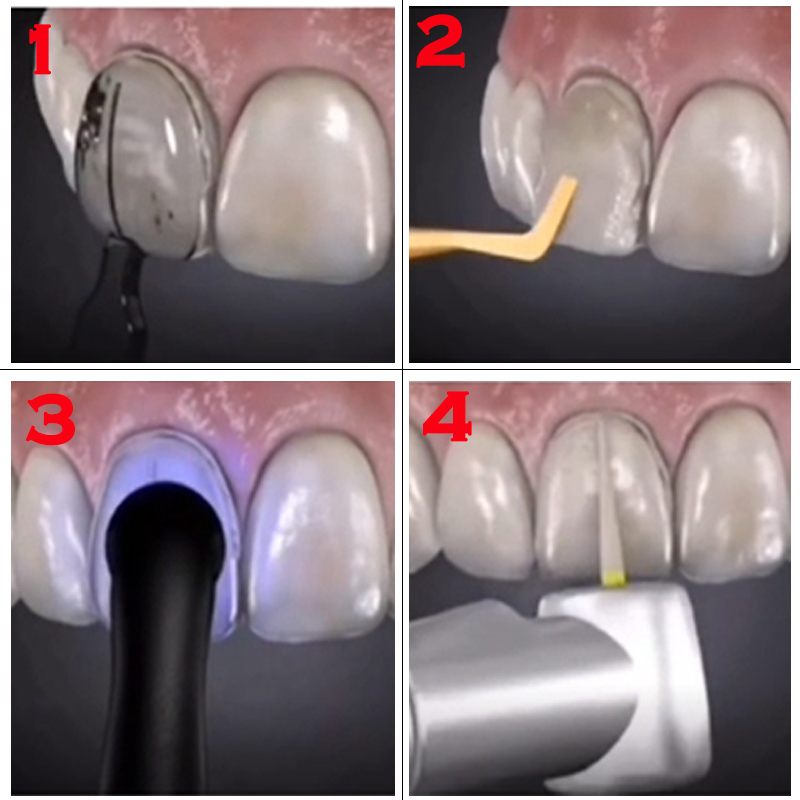 멸균 가능한 치과용 베니어 몰드, 앞니 미용 베니어,  - Teeth Whitening Quick 리뷰 및 가격